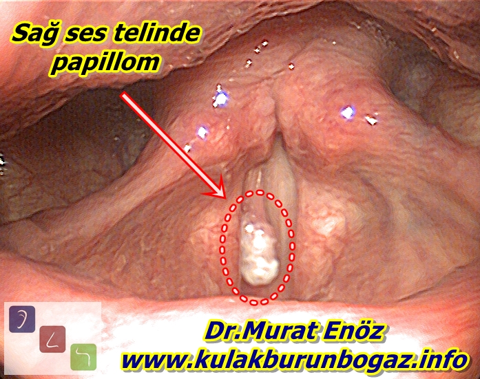 papilloma lezyon nedir