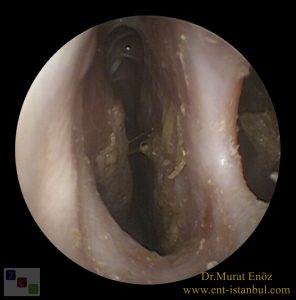Atrofik Rinit, nazal septum perforasyonu,