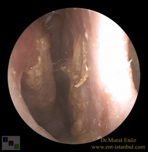 Atrofik Rinit, nazal septum perforasyonu, 