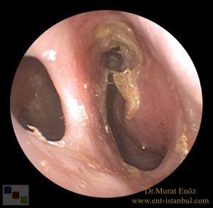 Atrofik Rinit, nazal septum perforasyonu, 
